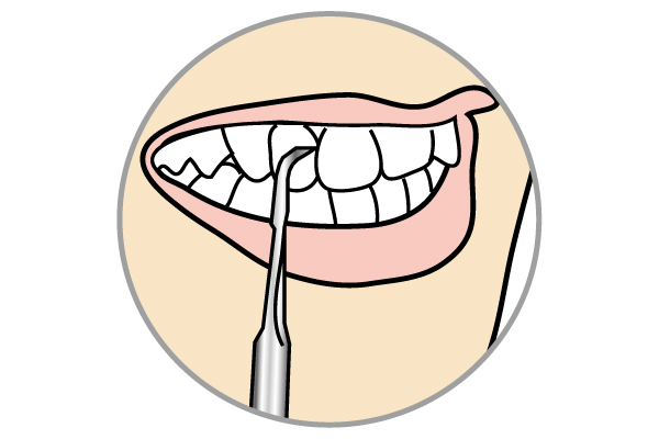 歯石とり