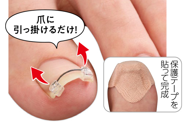 巻き爪ワイヤーガード